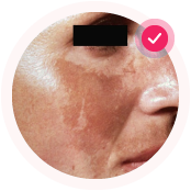 Поствоспалительные пятна